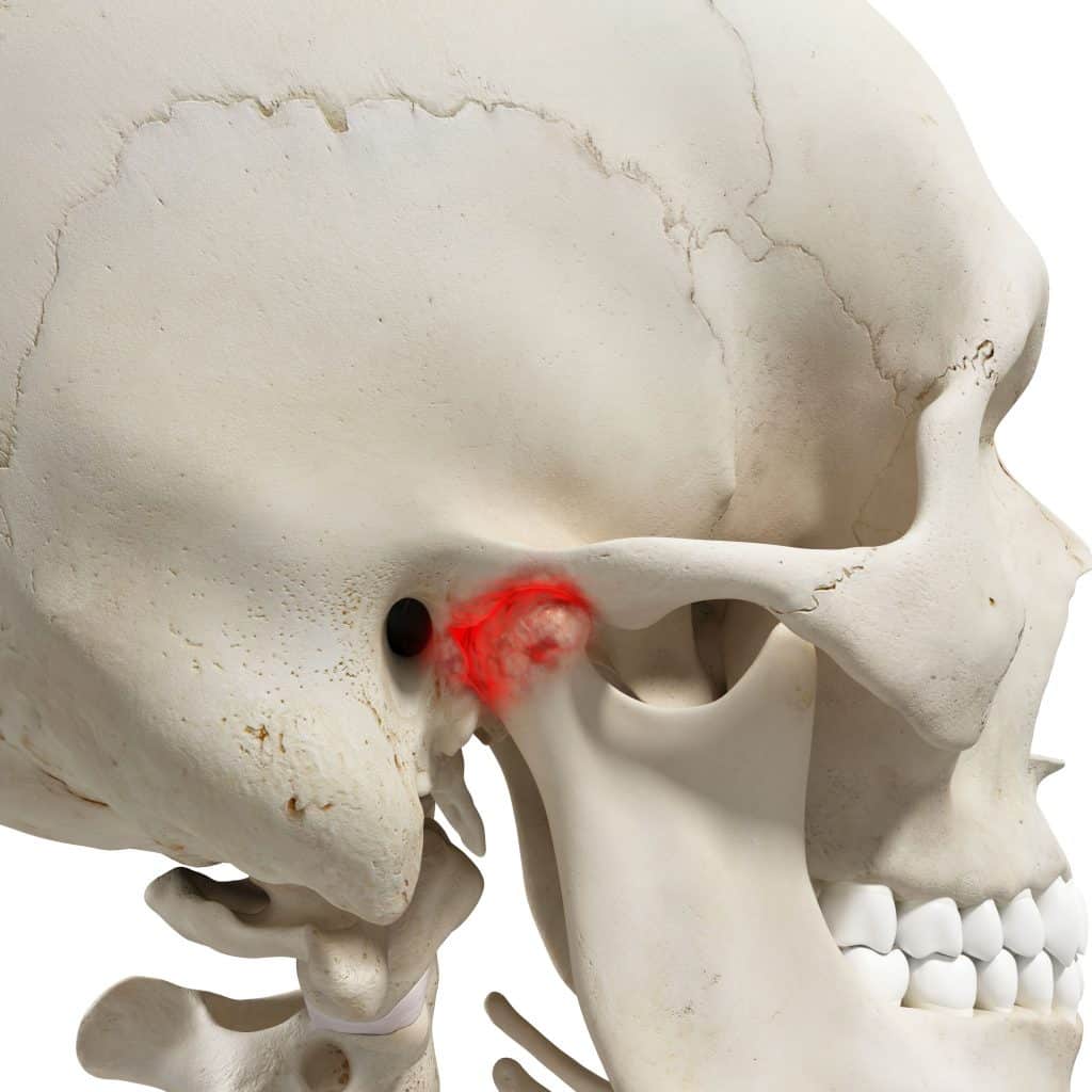 Human skull with jaw pain source highlighted in red